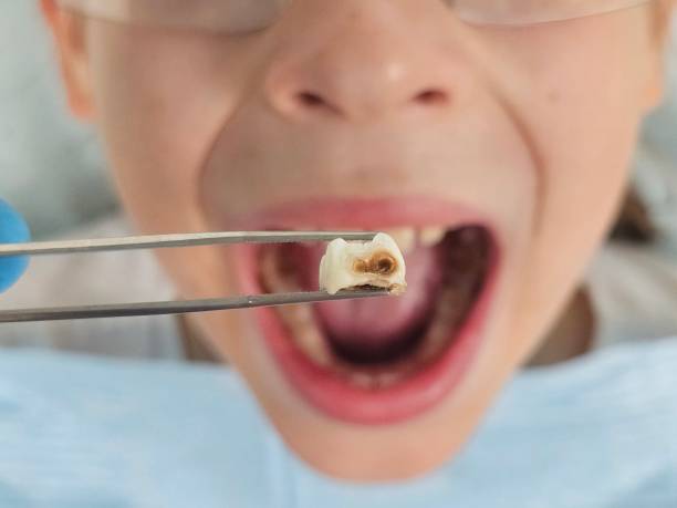 Best Emergency Treatment for Toothache in Osceola, IA